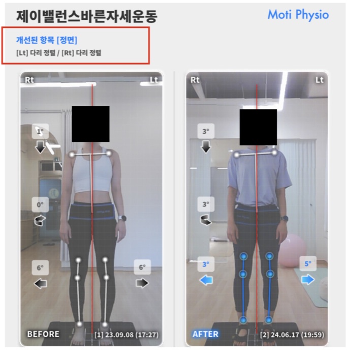 신도림 SNPE 3D 체형분석 비포 애프터 정면 - 양쪽 다리 정렬 개선