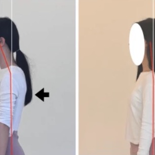신도림 거북목 비포 애프터 옆모습