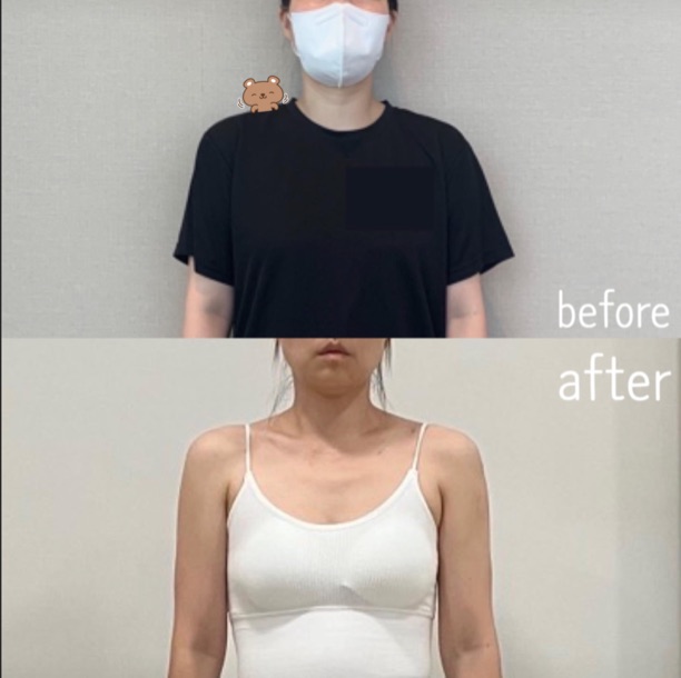 신도림 어깨비대칭 교정 비포 애프터 앞모습 - 어깨 높이 변화
